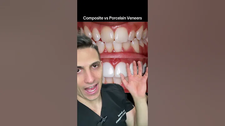 Porcelain veneers are MUCH better than composite veneers