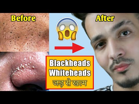 Blackheads ओर Whiteheads से हमेशा के लिए छुटकारा पाएं || Remove Blackheads & Whiteheads At Home ||