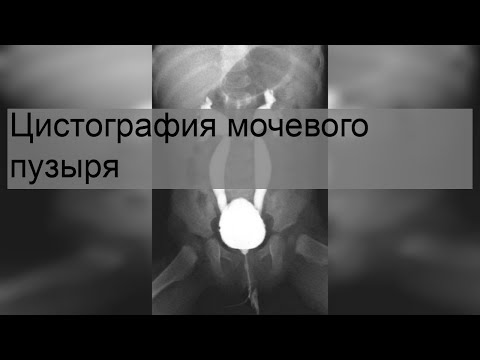 Цистография мочевого пузыря