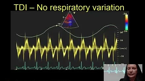 Assessment and management of the right heart - Dr ...