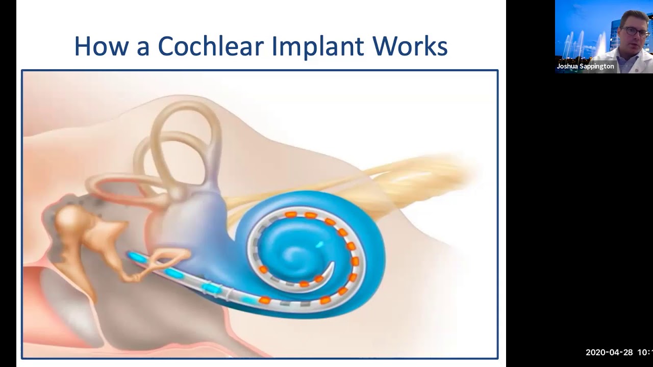 Cochlear Implementation Cochlear implantation - Dr. Joshua Sappington - YouTube