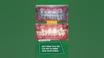Quá trình thay đổi của một ca niềng răng #nhakhoangoctuan #nhakhoauytinthaibinh #kienthucnhakhoa