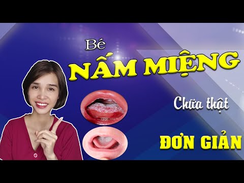 Video: 3 cách để biết bạn có bị nấm miệng hay không