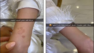 طريقة اخفاء اثار الحروق بالمكياج النتيجة رهيبة  | سناب فرات ابا الخيل