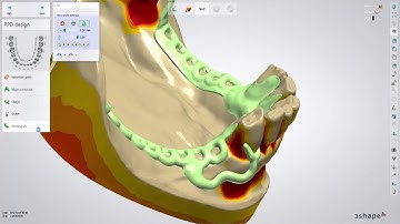 231 - Lower RPD Class II mod 1