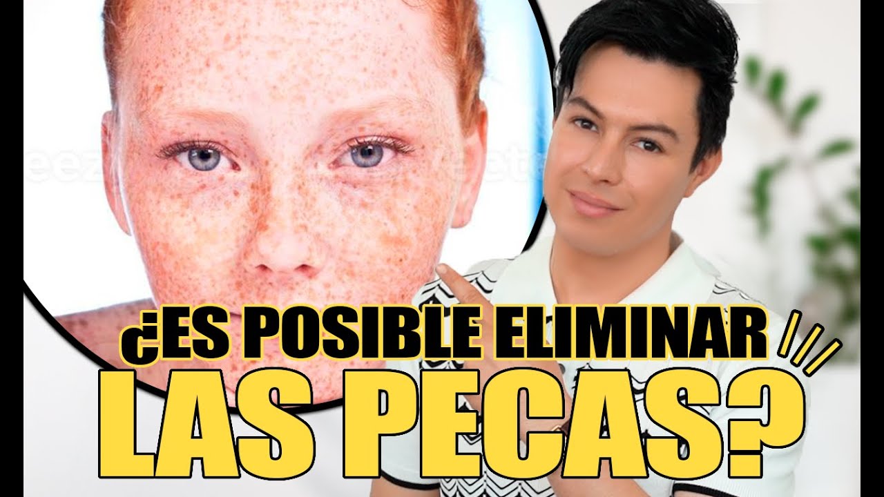 Cómo Eliminar Pecas de La Cara | Yasmany - YouTube
