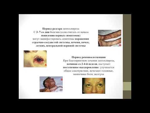 Лептоспироз