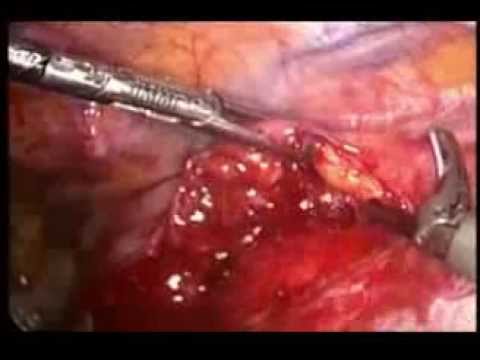 Timectomia toracoscópica / Thoracoscopic thymectomy camera iphone 8 plus apk