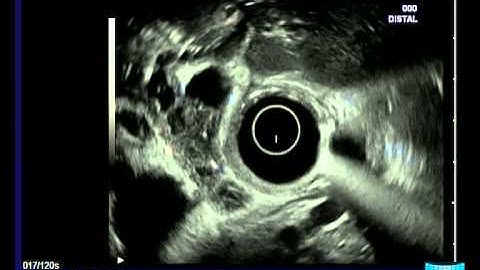 Cholangiocellular Carcinoma (T2)