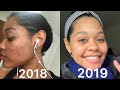 My Skin Care Routine to Clear Up Acne | No Accutane!