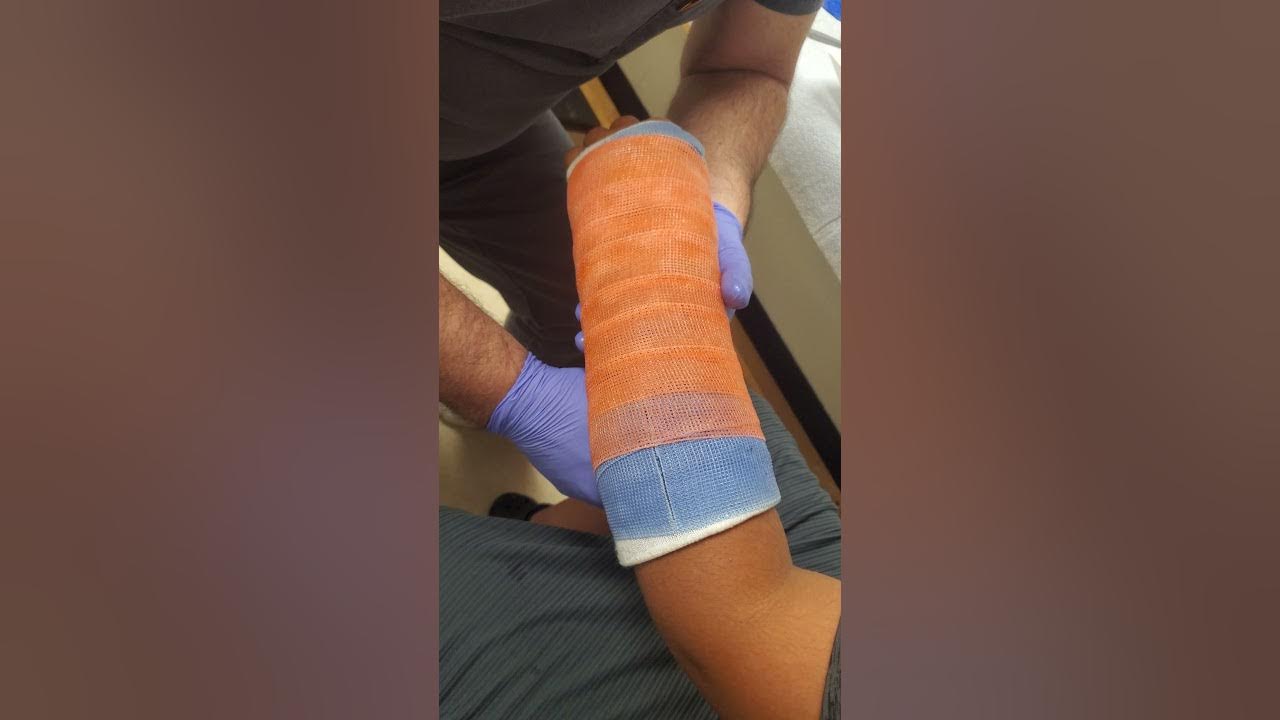 Post Operative Fiberglass Cast Overwrap, How to... YouTube
