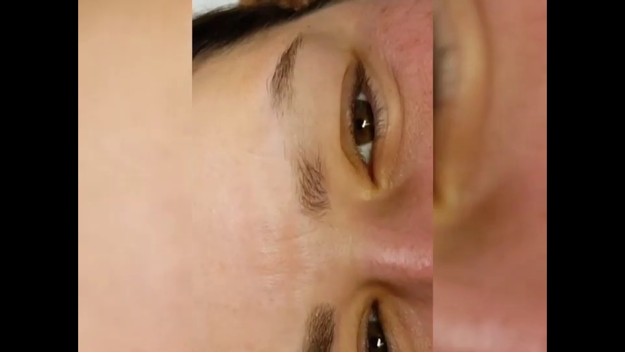 Eyebrow recovery after Alopecia