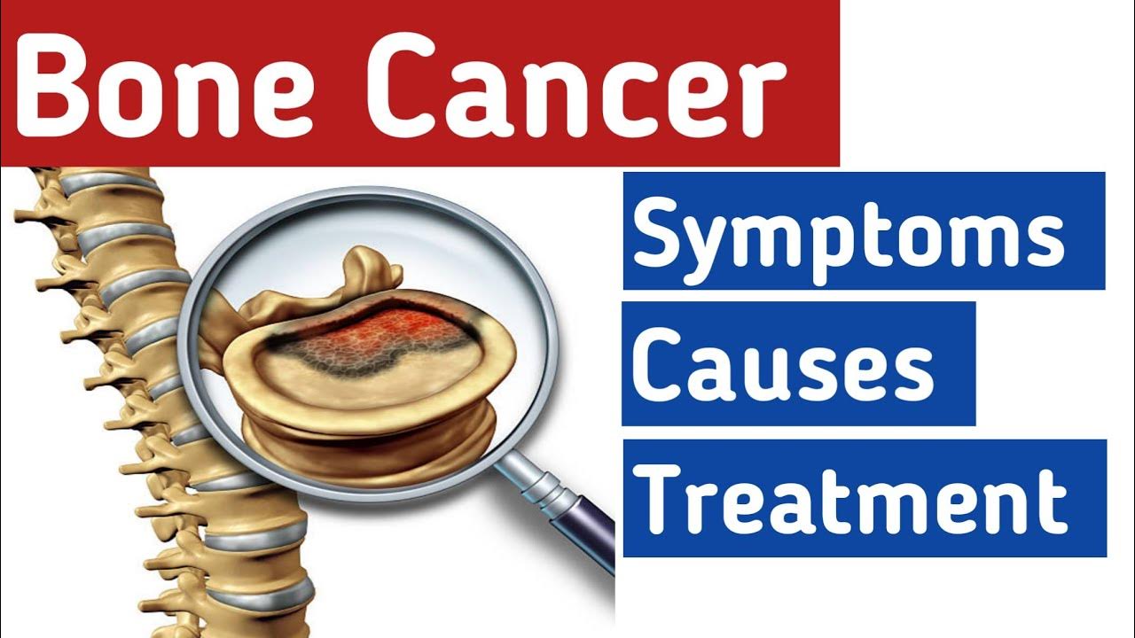 cancer-in-bones-stages-causes-diagnosis-bone-cancer-symptoms-bone