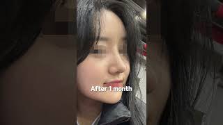 셀카 찍을 때 너무 만족해요🧡 | 👃 니트성형외과