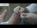 Gout Removal In Toe