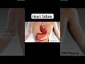 #Heart failure animation # Heart attack # 2023