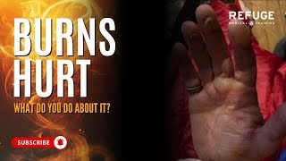 Burns Hurt, Are You Prepared? | Burn Dressing Preparedness
