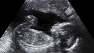 Hope for the Future: Having a Healthy Pregnancy While Living with HIV Chapter Two