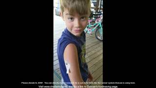 Duncan's Type-1 Diabetes Sensor Insertion