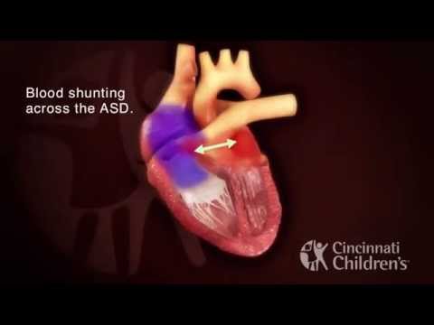 Video: Defecto Cardíaco Congénito (anomalía De Ebstein) En Perros