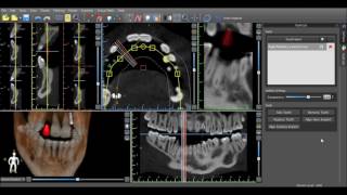 Information Blue Sky Plan 3 Tutorial  Virtual Teeth Guide