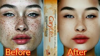 Carylite Cream | Remove Pigmentation | Dark spot | Acne & Acne scars | Brijwasi Girl