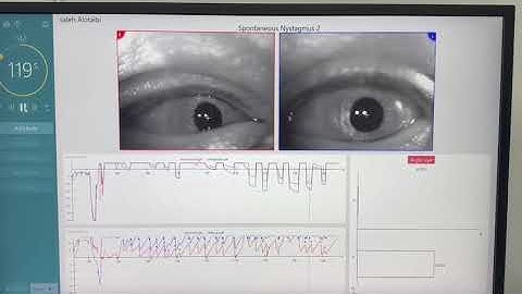 Bow tie nystagmus (Down beating nystagmus + square jerky waves)