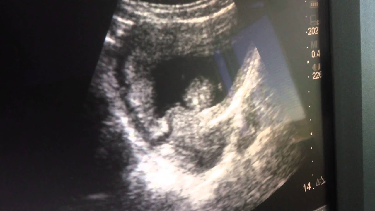 13 Weeks 2 Days Pregnant Youtube