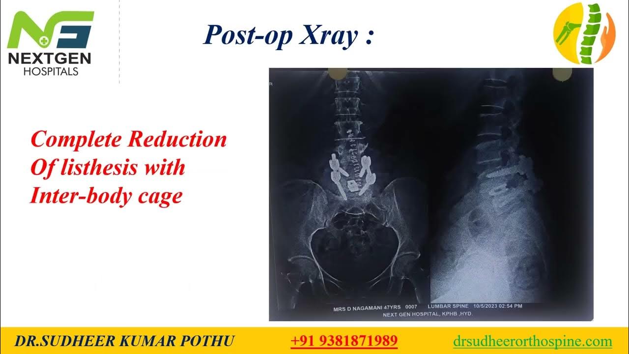 Lumbar Transforaminal Interbody Fusion For Grade Ii L4 L5 Lytic