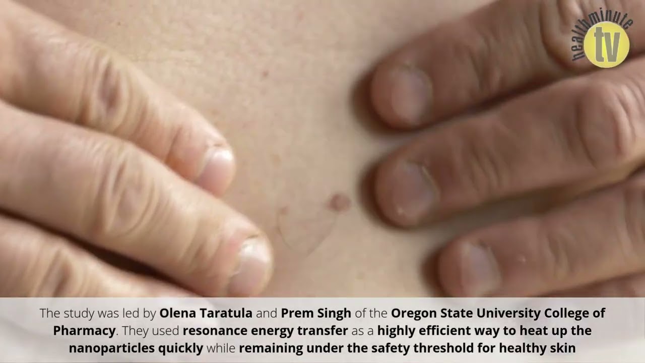 VIDEO: Researchers develop nanoparticles to remove melanoma with low-power laser light