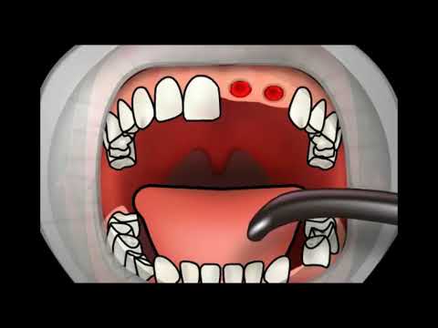 Video: Alveolita Găurii După Extracția Dinților