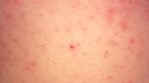 Measles: An interview with Erin Archer Kelser, RN,...