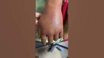 Thumbnail of Snakebite fang marks with local cellulitis #doctor #medicine #resident #justmedicothings
