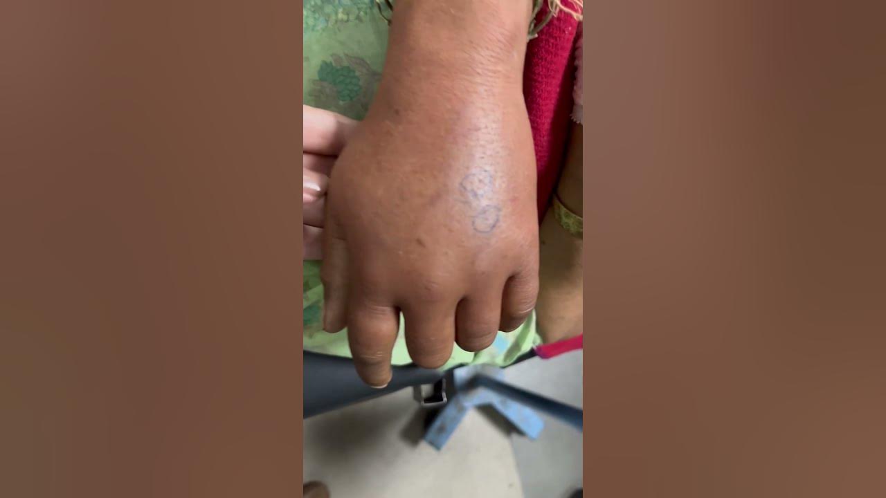 Snakebite fang marks with local cellulitis #doctor #medicine #resident #justmedicothings