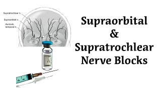 Anesthetic Blocking of the Supraorbital and Supratrochlear Nerves