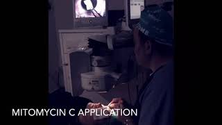 IDesign Custom Correction for Astigmatism