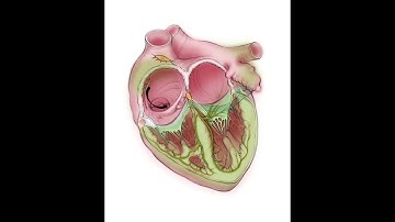 Ablation of cavotricuspid isthmus–dependent atrial flutter