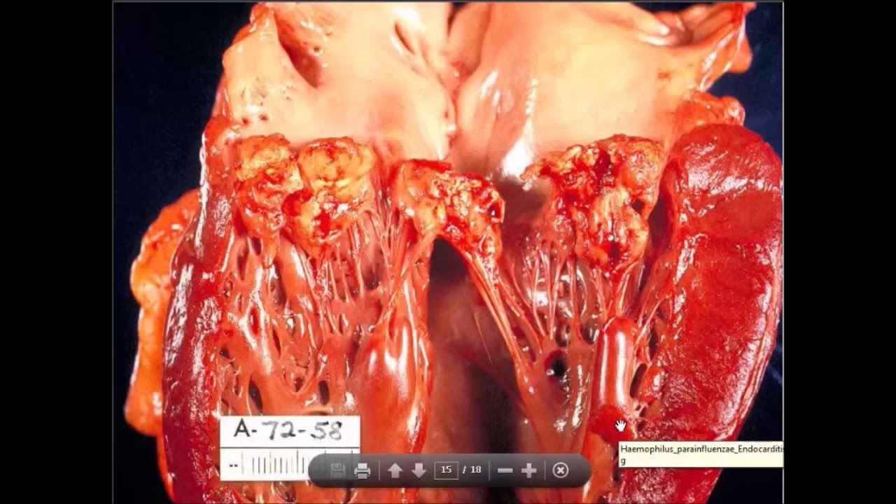 Rheumatic Heart Disease - YouTube