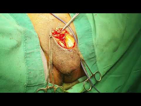 Total penectomy + perineal urethrostomy for penile cancer