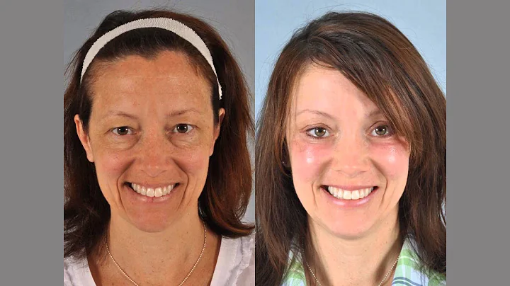 A Complete Micromidfacelift Transformation-K...  S...