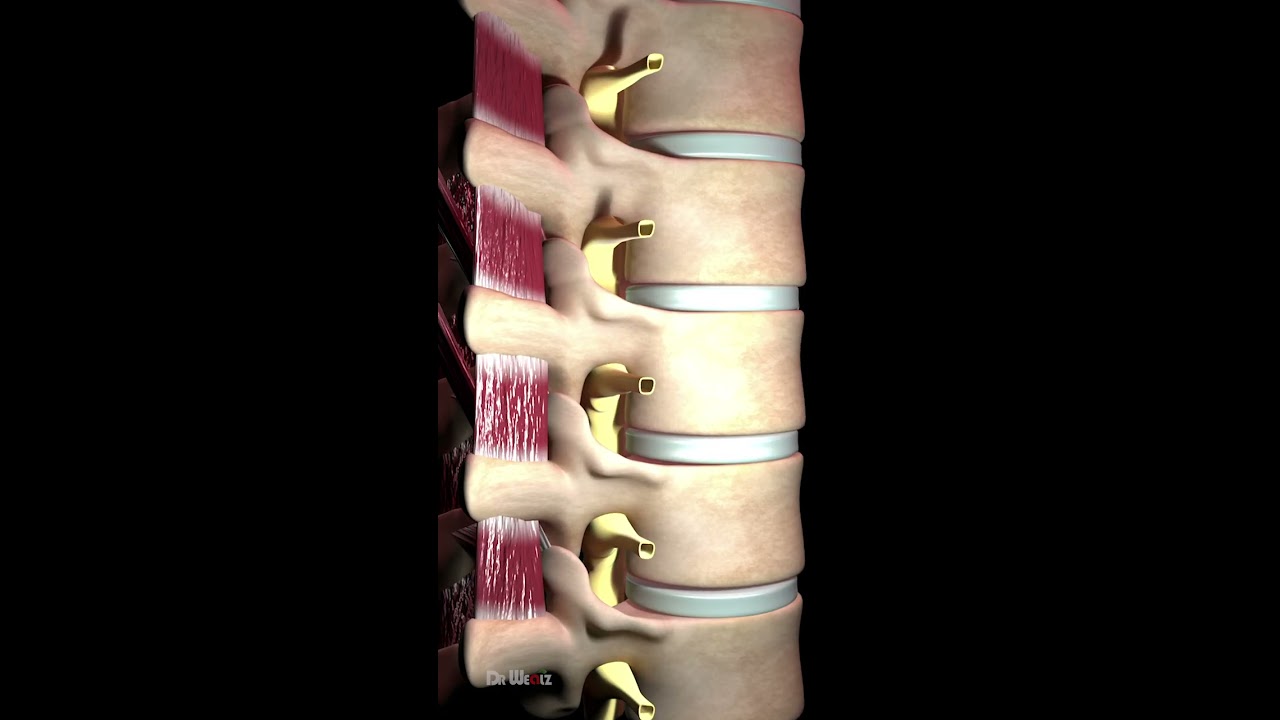 Bulging Disc Explained Animation 