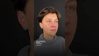 Омоложение верхней части лица и лифтинг нижней - результат комплекса пластических операций