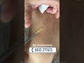 Procedura di scleroterapia