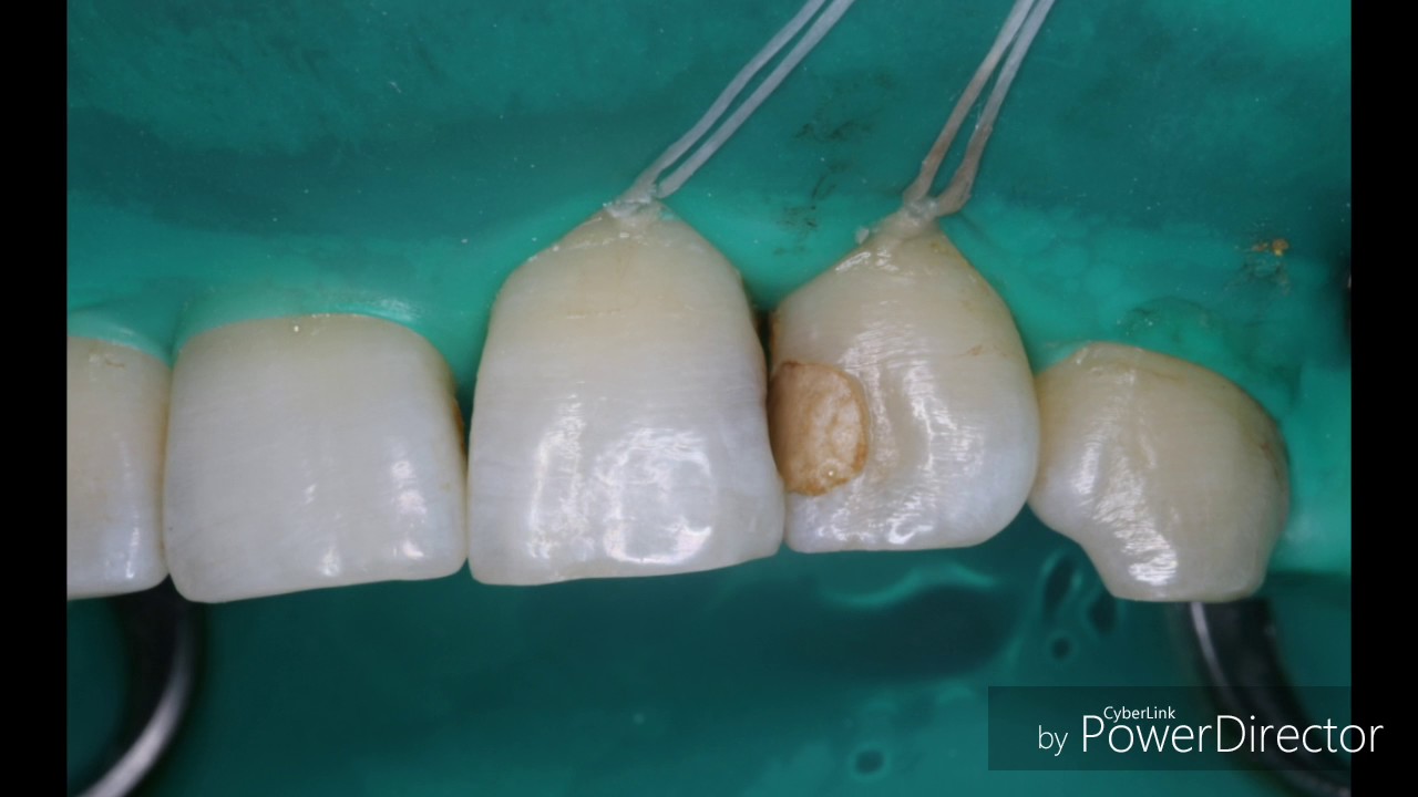 class 3 composite restorations youtube composite restoration