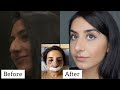 Nose Job Experience Vlog |Doctor, Surgery, Recovery, Before and After!