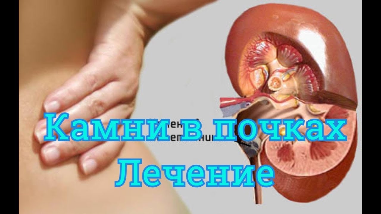 Камни в почках. Как удалить камни из почек без операции?