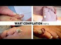 WART BURNING COMPILATION (Part 4) | Dr. Paul