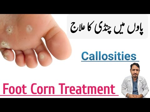 Foot Corn Treatment Urdu Hindi| Corn ke ilaj in urdu | Chandi Ka Ilaj | Irfan Azeem |