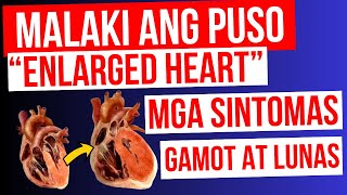 ENLARGED HEART / Lumalaki ang PUSO  Mga Sintomas, Gamot at LUNAS | Cardiomegaly, Heart Failure