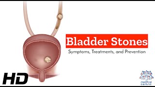 Bladder Stones Symptoms And Your Path To Relief